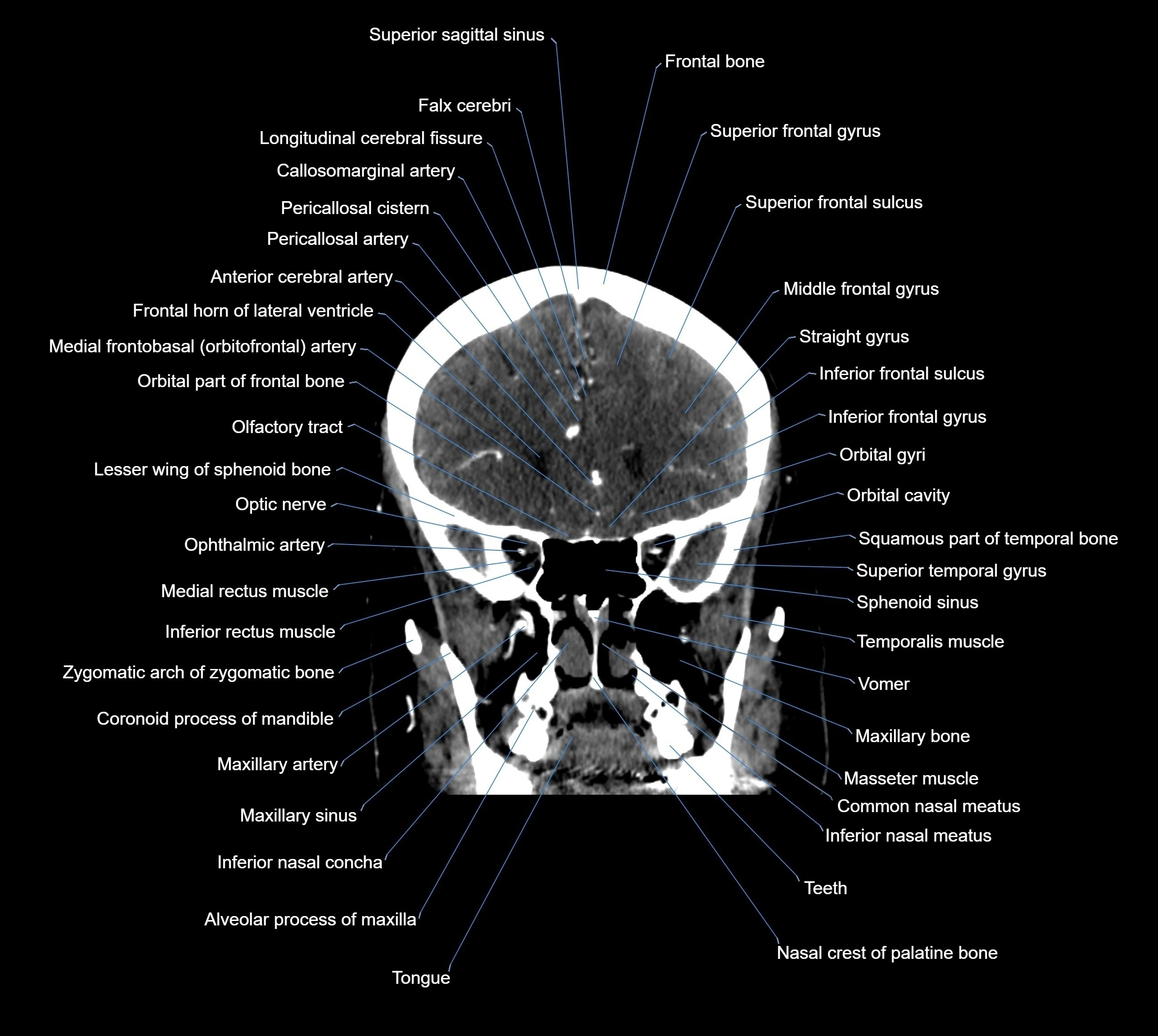 CT Brain coronal cross sectional radiology anatomy image  -img-00001-016.webp